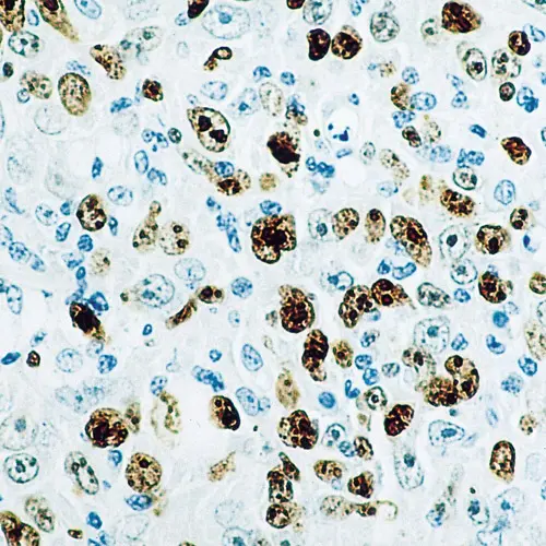 Eksempel på IHC farging med Ki-67, en proliferasjonsmarkør